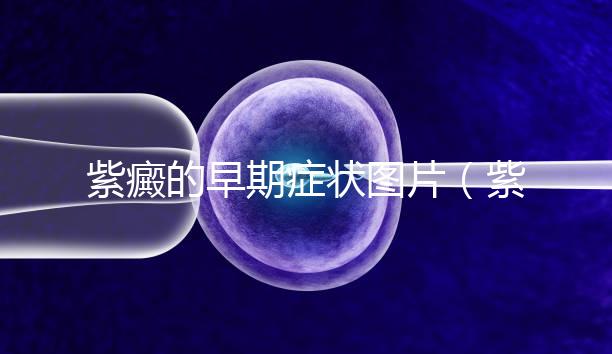 紫癜的早期癥狀圖片（紫癜是小病還是大病）