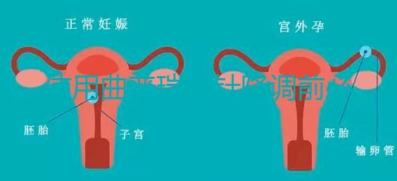 使用曲普瑞林針降調(diào)前必看:3大作用對(duì)比5大副作用