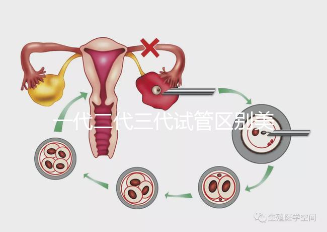 一代二代三代試管區別美琳達(一代二代三代試管區別及價格)