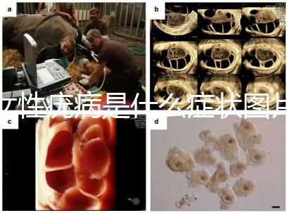 女性疣病是什么癥狀圖片（女生下面長了疙瘩圖片）